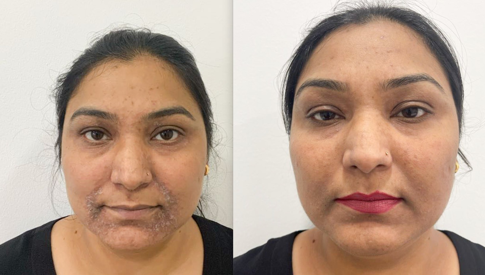 Birmingham Women Puts Stop To Face Eczema With LED Light Therapy